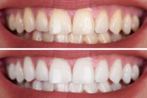 cleveland teeth whitening