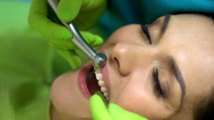 cleveland dental bonding