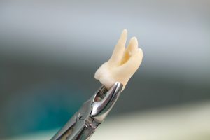 cleveland tooth extraction