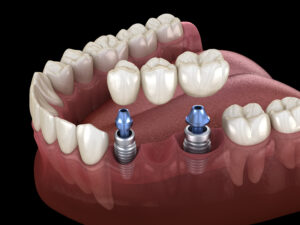 cleveland dental implants