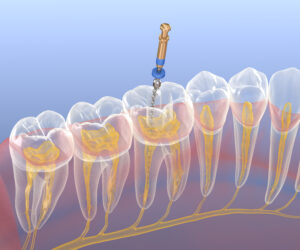 Cleveland root canal