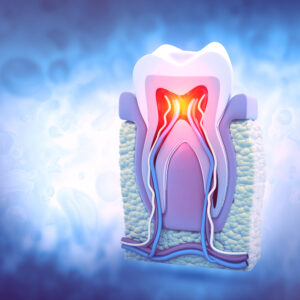 cleveland root canal