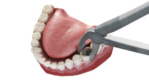 cleveland tooth extraction surgery