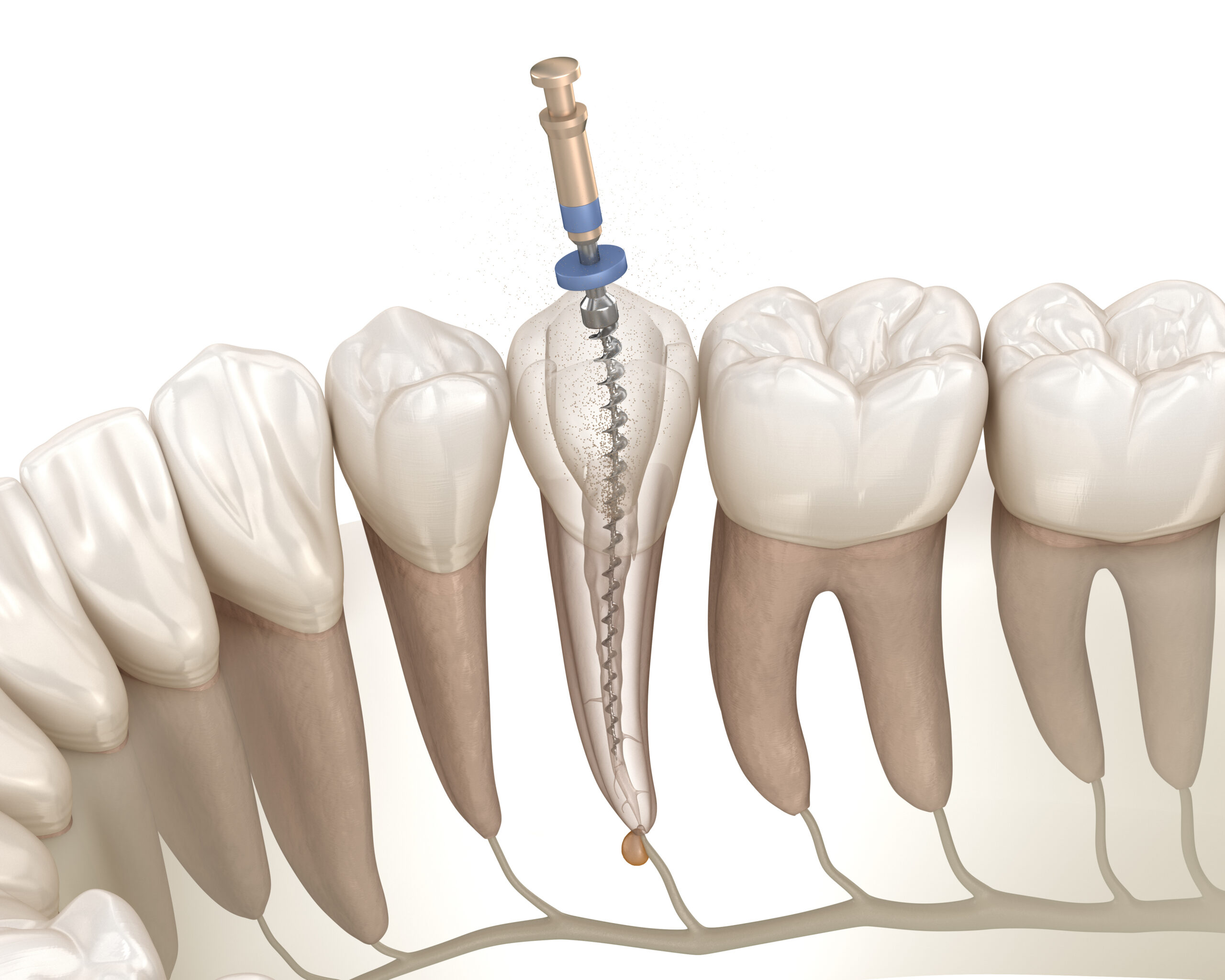 cleveland root canal therapy