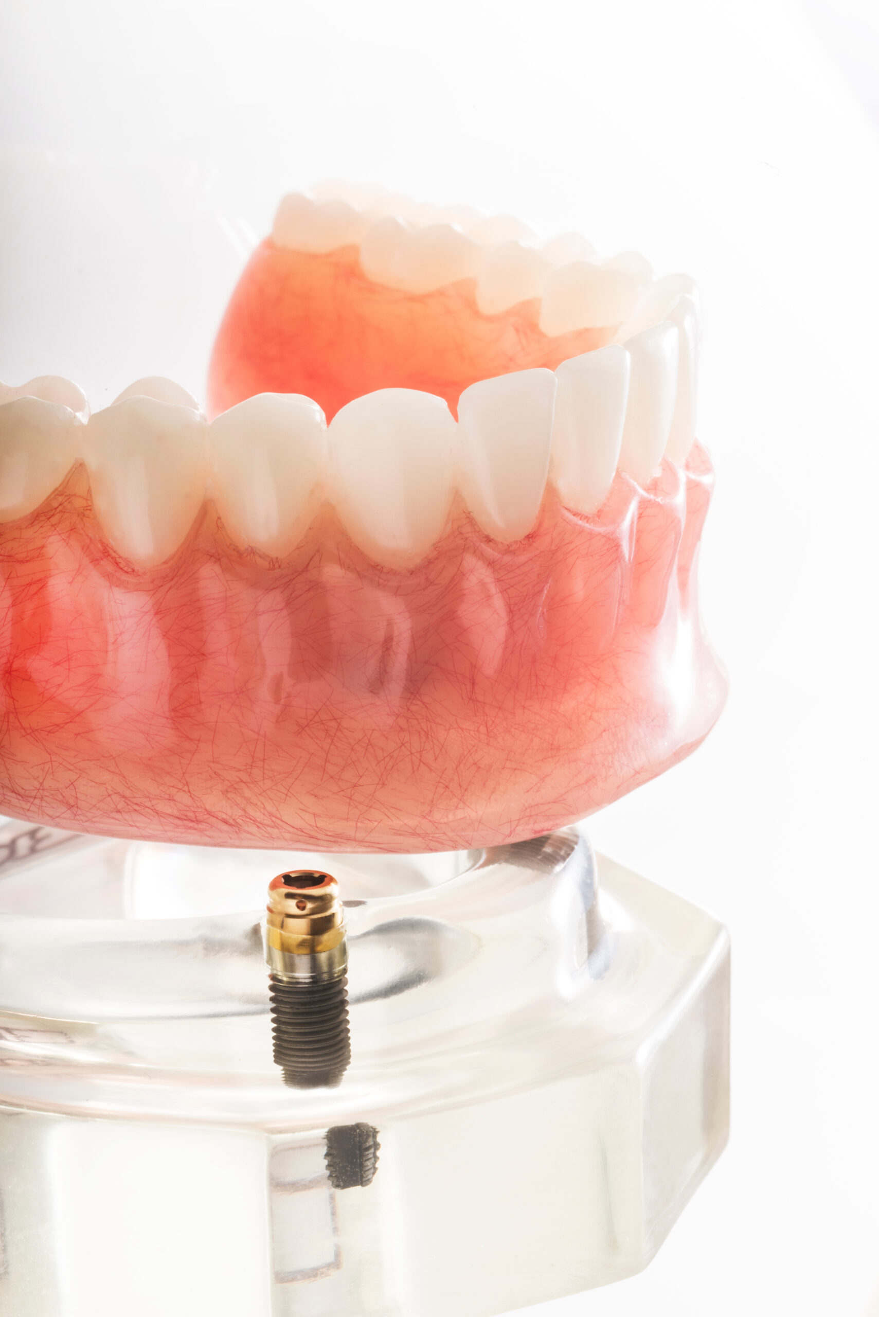 cleveland implant denture placement