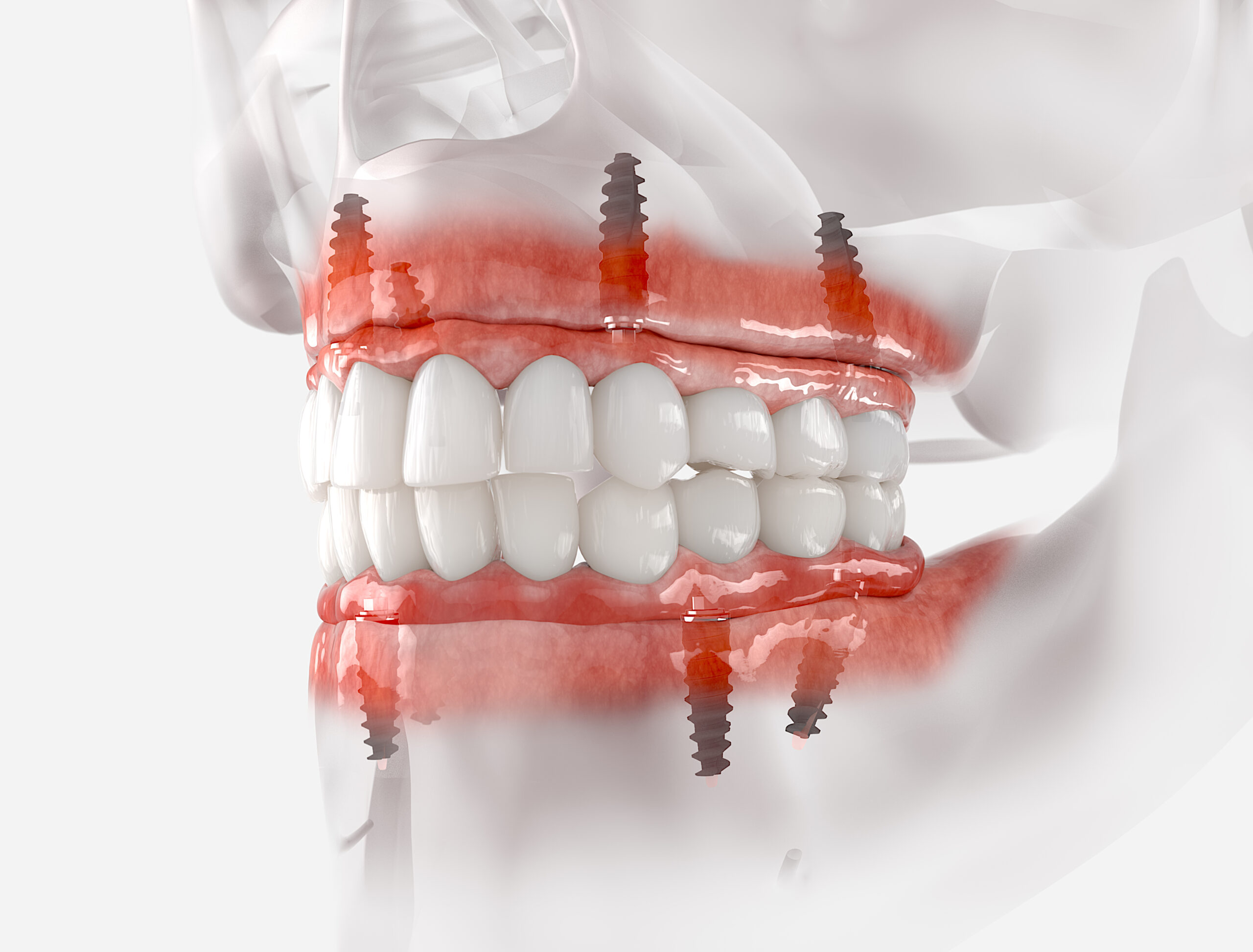 cleveland fixed dentures