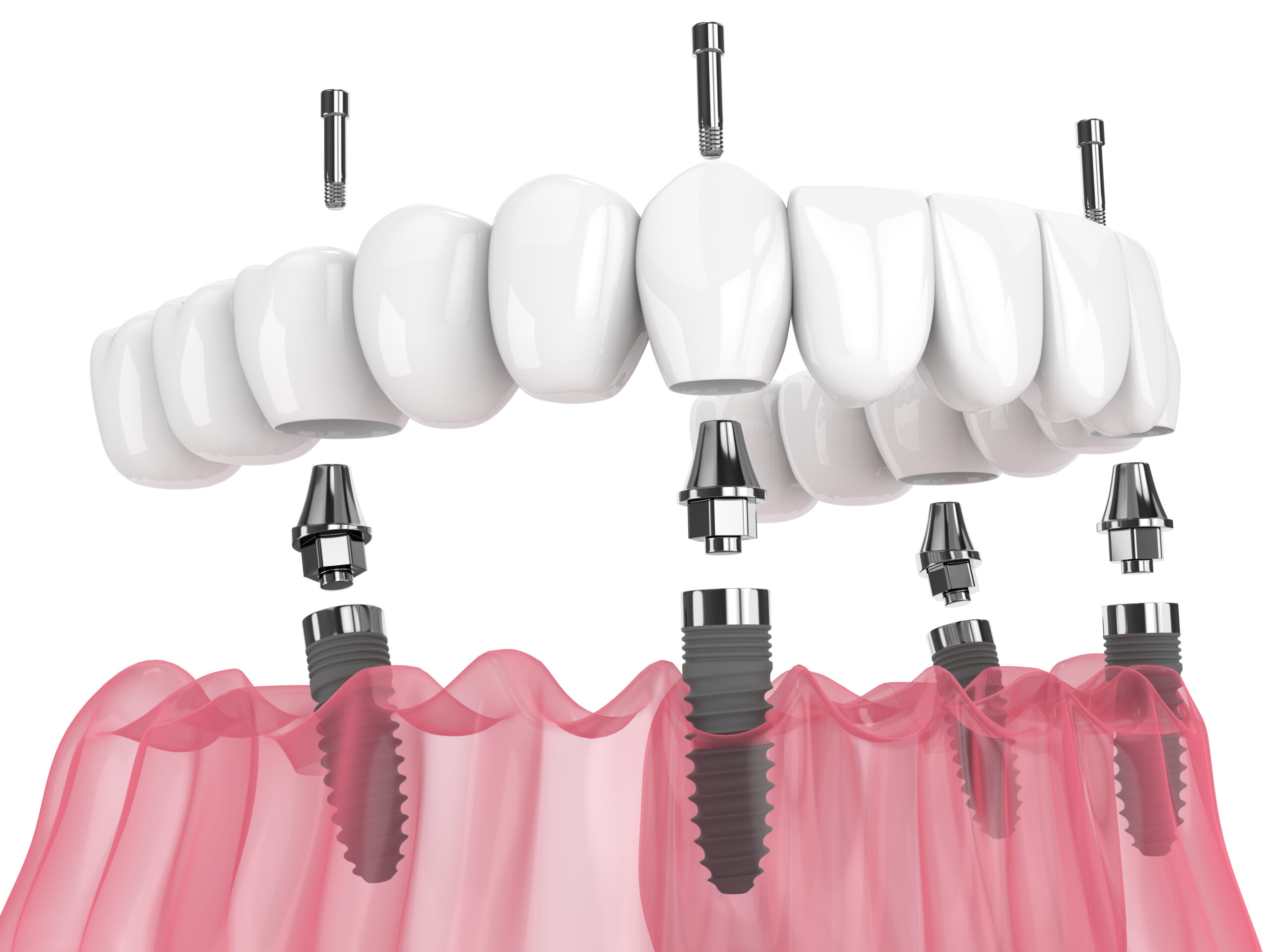 cleveland implant denture placement