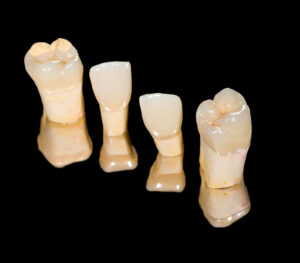 cleveland dental crowns