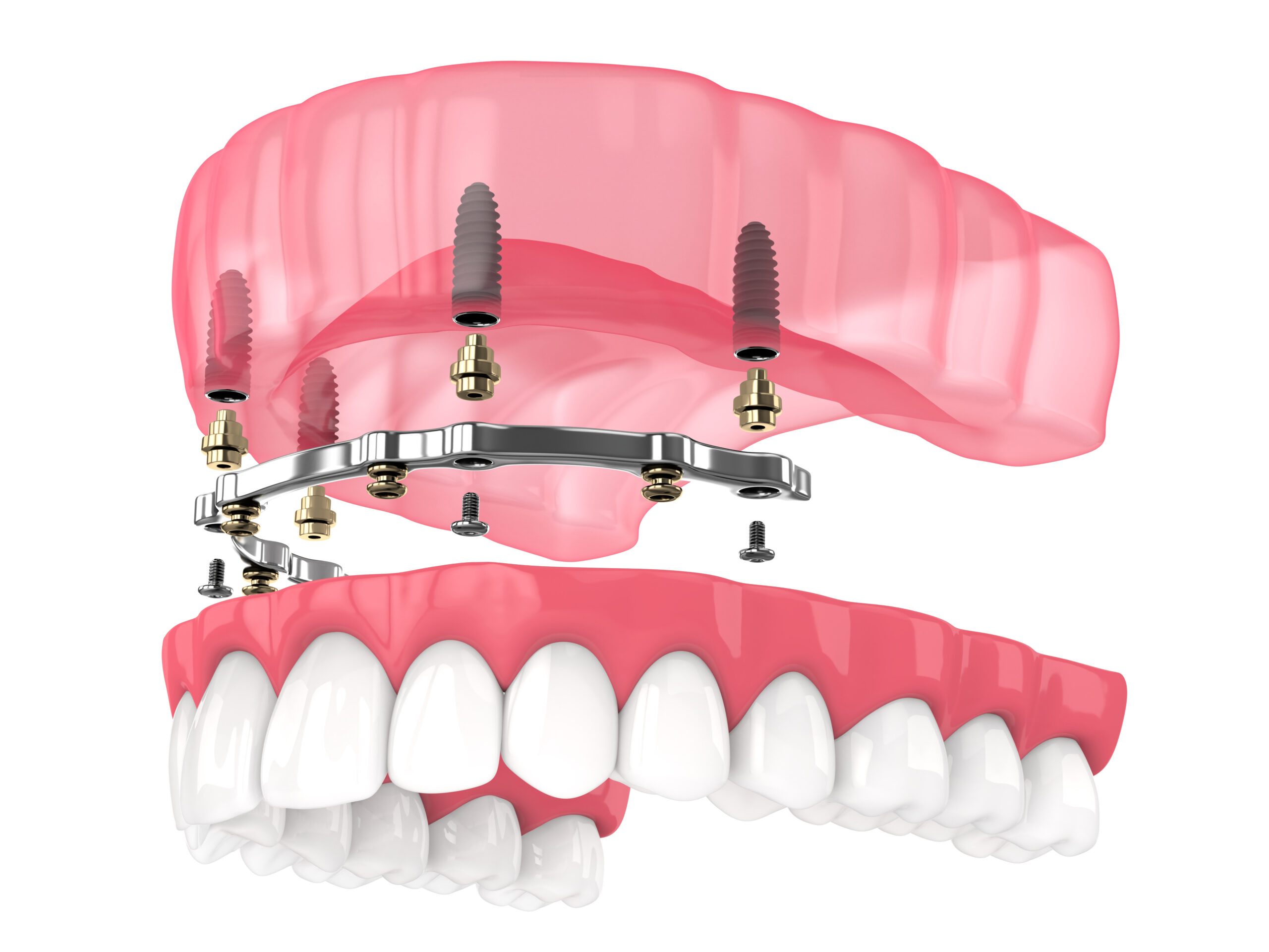 cleveland implant dentures