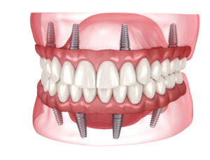 cleveland implant dentures