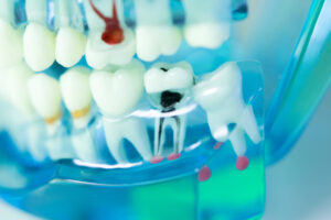 cleveland root canal
