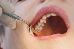 Cleveland Family Dentistry offers tooth-colored fillings to restore your teeth after cavities.