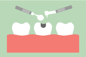 Cleveland, TX dentist offers fillings that can restore your teeth 